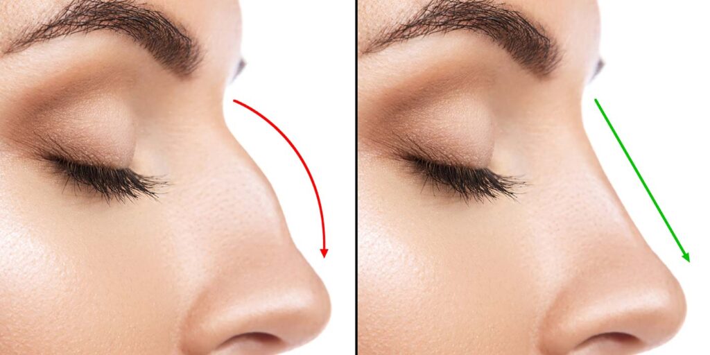 Rhinoplasty in London