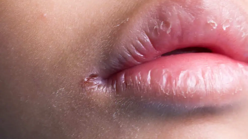 Cracked Lip Corners: Protect Moisture and Avoid Ongoing Irritation